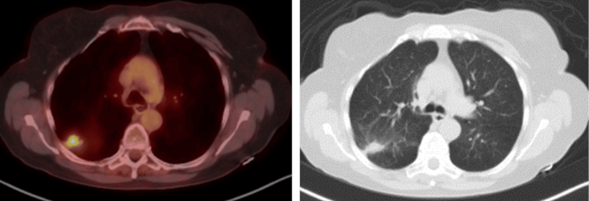 2020 study- Biopsy-proved adenocarcinoma. SUV Max 5.4