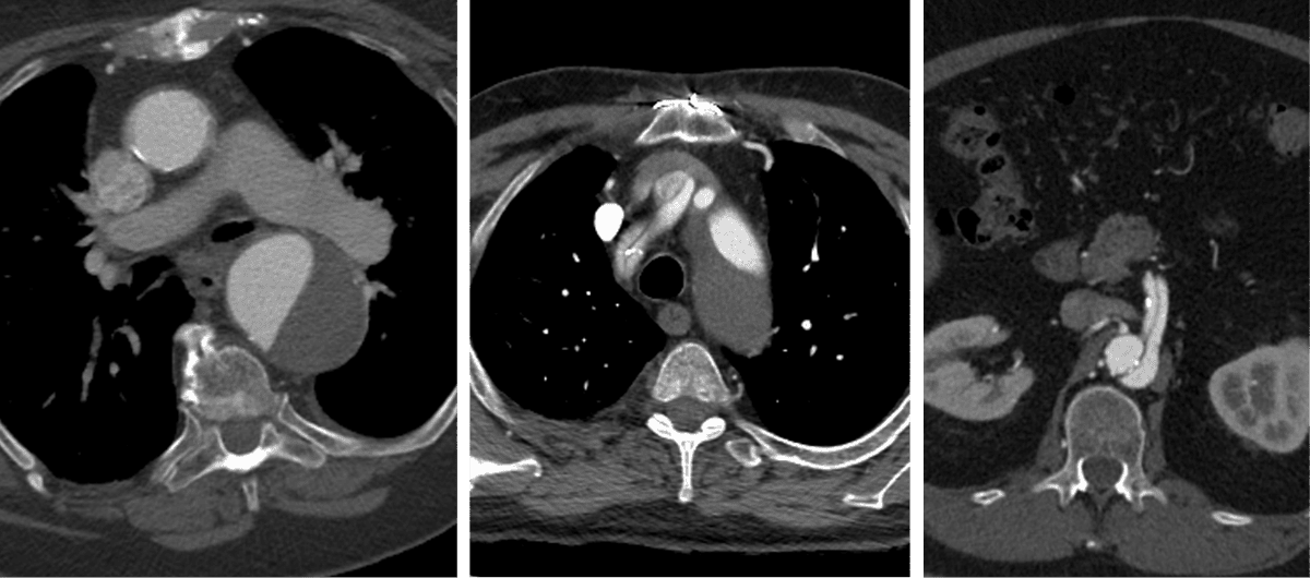 A set of three CT scan images showing cross-sectional views of the chest and abdomen, ideal for Rad to Rad Learning, featuring the heart, lungs, spine, aorta, and abdominal organs in grayscale.