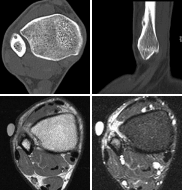 Four black and white medical images of a bone, likely CT and MRI scans, show cross-sectional and side views with a round mass near the bone’s edge. Various tissue densities and structures are visible, providing detailed visuals ideal for Rad to Rad Learning.