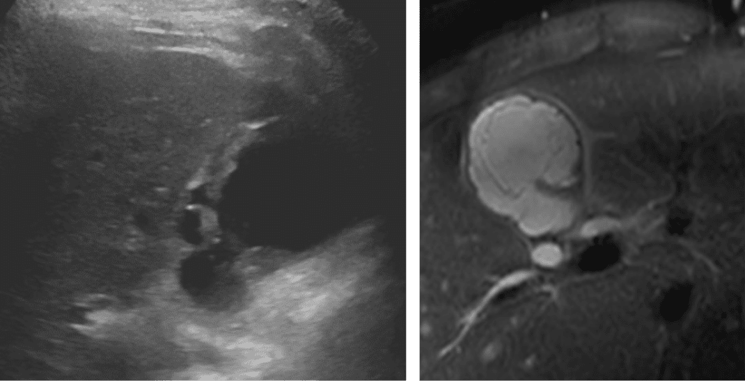 Side-by-side medical images: left is an ultrasound showing a dark, round mass; right is an MRI with a bright, circular structure near the spine, possibly showing an abdominal aortic aneurysm. This comparative Rad to Rad Learning approach enhances diagnostic understanding by juxtaposing key imaging findings across modalities.